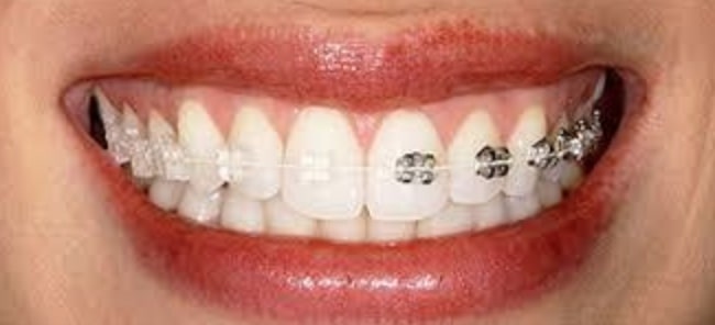 Ortodontia/Aparelho Fixo