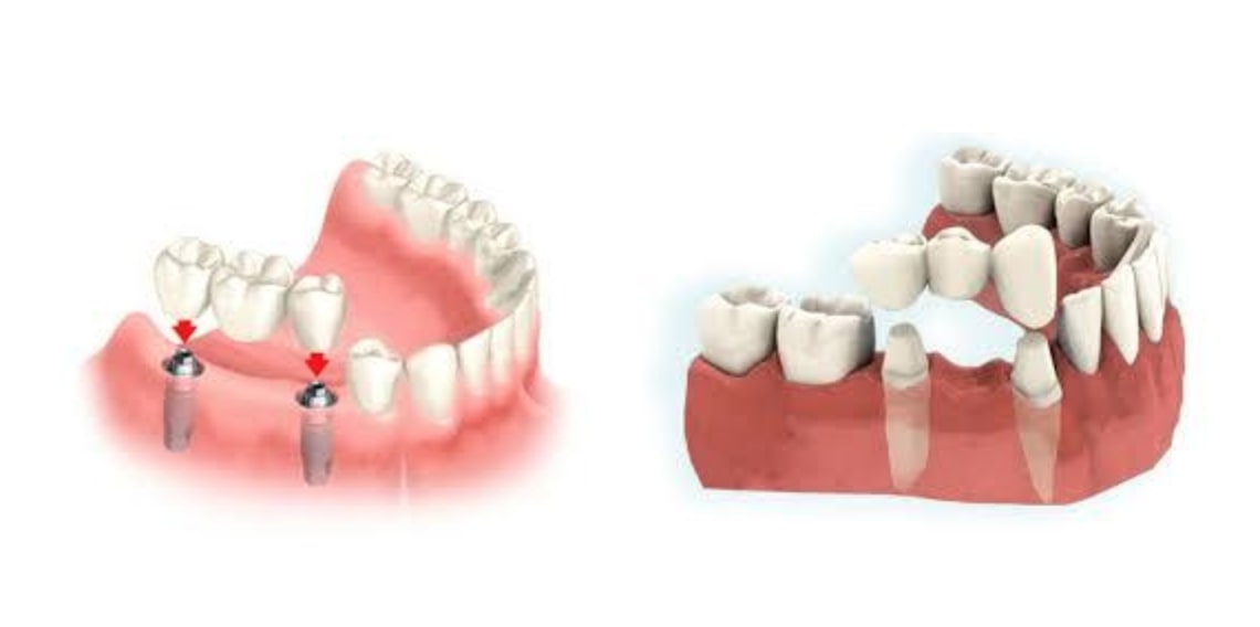 Prótese Dentária Fixa
